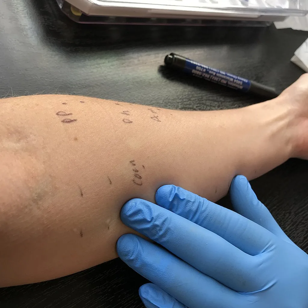 food allergy test